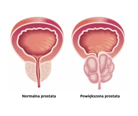 Normalna prostata - Nahrin